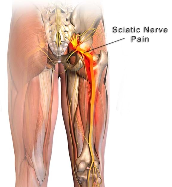Chiropractic Solutions|Norwood|Sciatica and Disc Injuries